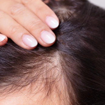 Hair Loss Therapy